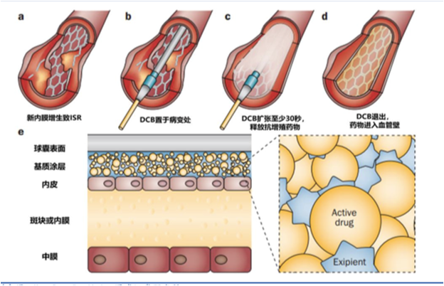 新型三氧化二砷药物洗脱球囊
